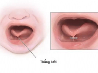 Cắt Dính Thắng Lưỡi, Nong Hẹp Bao Quy Đầu Ở Trẻ: Khi Nào Cần Thực Hiện?