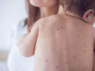 Bệnh sởi là một bệnh truyền nhiễm cấp tính do virus gây ra, thường gặp ở trẻ em. Dưới đây là những dấu hiệu quan trọng của bệnh sởi mà cha mẹ cần biết: