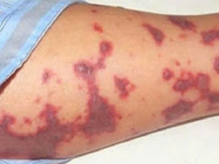 Viêm Não Mô Cầu Ở Trẻ Em: Dấu Hiệu, Cách Điều Trị Và Lịch Tiêm Vắc Xin Đầy Đủ